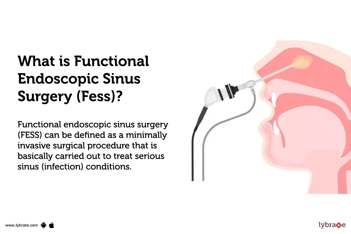 Functional Endoscopic Sinus Surgery Treatment Procedure Cost