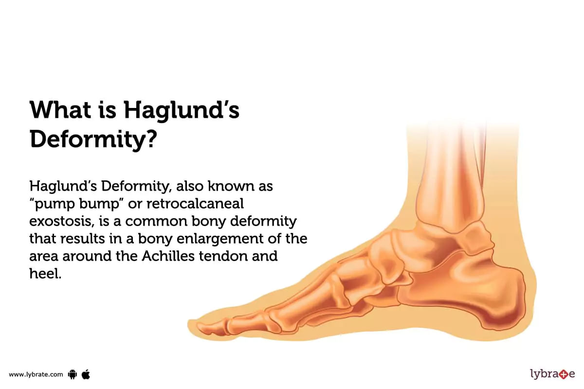 Haglund S Deformity Causes Symptoms Treatment And Cost