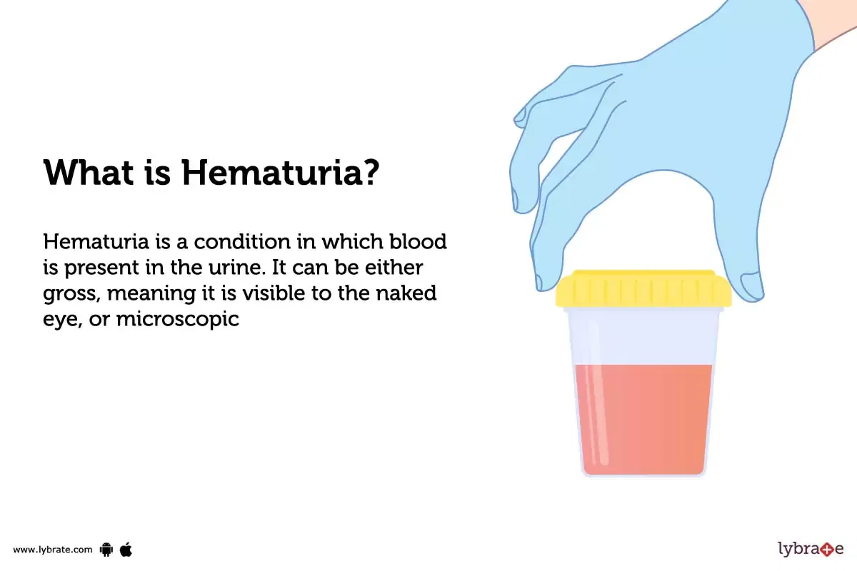 Hematuria Causes Symptoms Treatment And Cost 