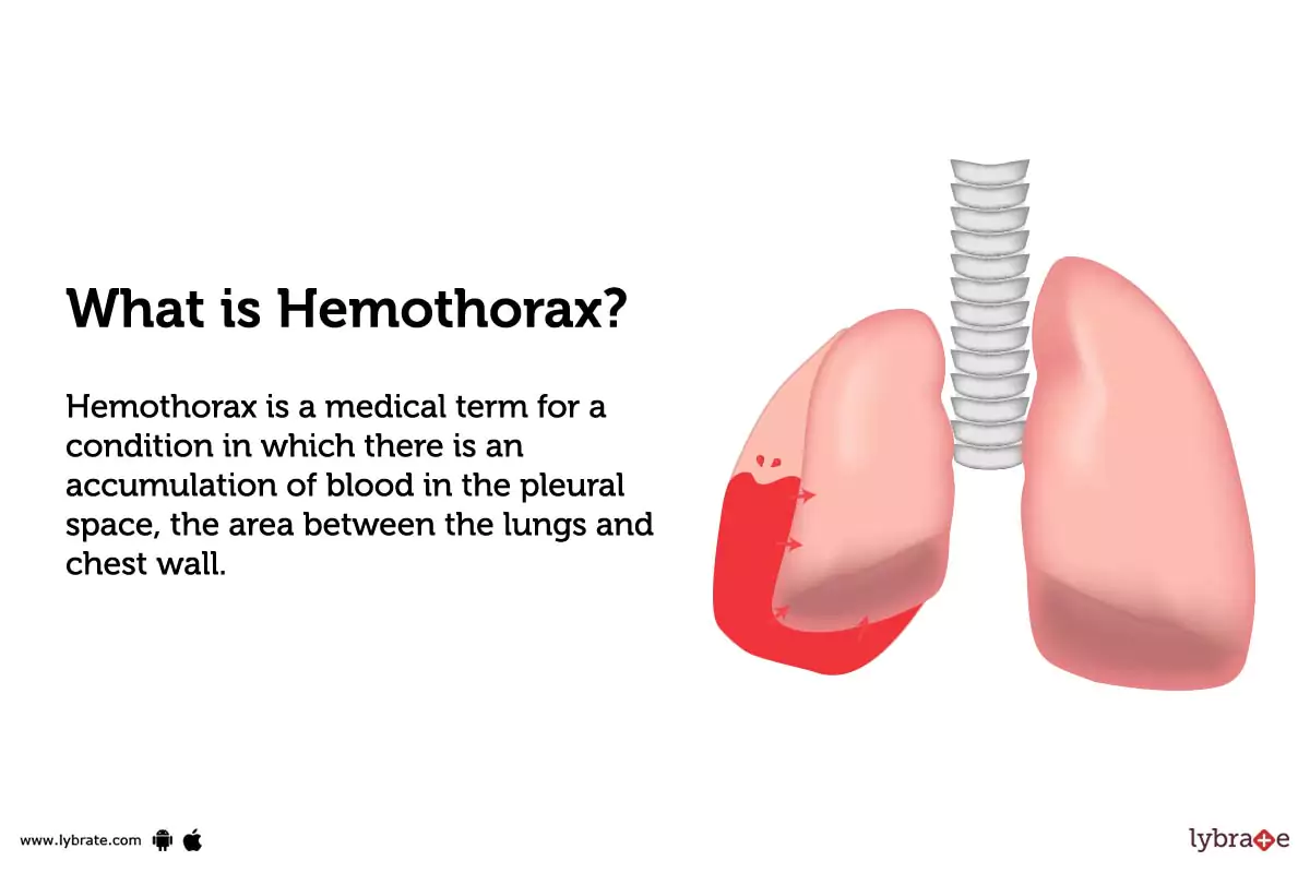 Hemothorax Causes Symptoms Treatment And Cost popular-topics-teachim