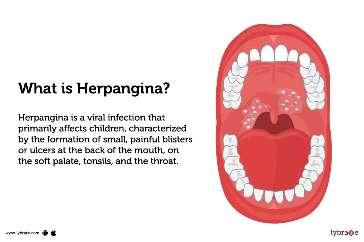 herpangina-causes-symptoms-treatment