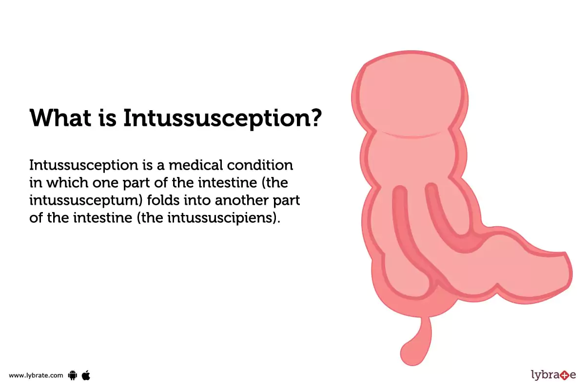 Intussusception Causes, Symptoms, Treatment and Cost