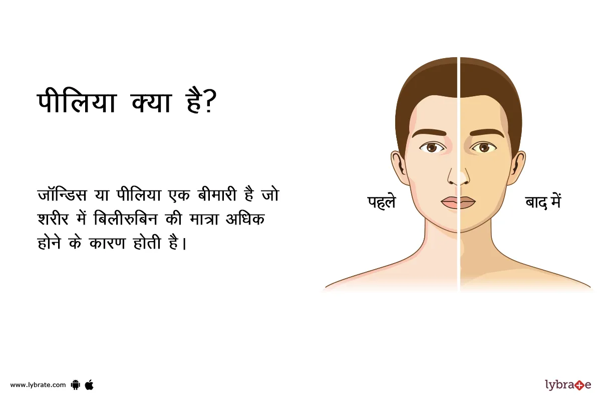 पीलिया के लक्षण, कारण, इलाज, दवा, उपचार और परहेज Jaundice Ke Karan, Lakshan, ilaj, Dawa Aur Upchar