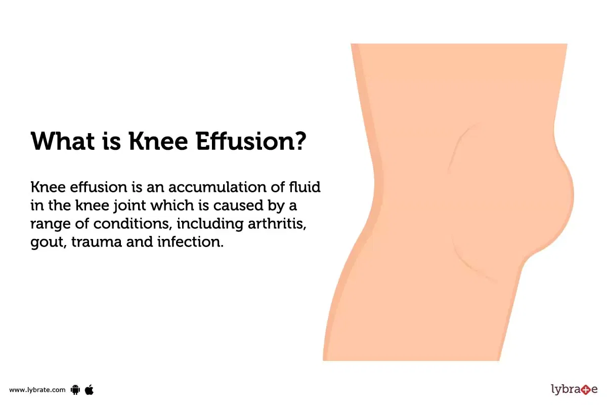 knee-joint-effusions-are-only-reliably-seen-on-lateral-projections-the