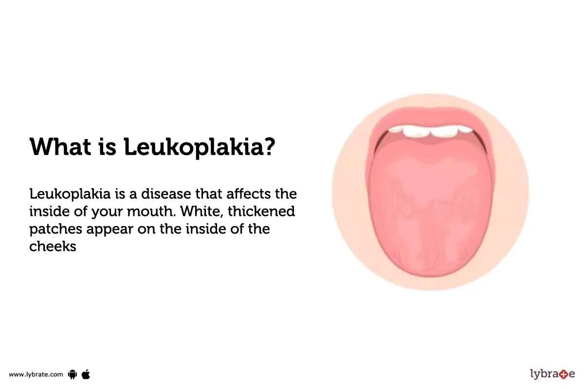 Leukoplakia Symptoms Causes Treatment Cost And Side Effects 8755