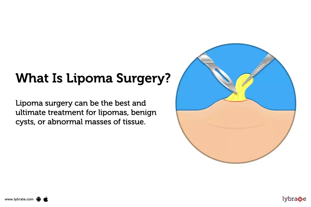 Lipoma Surgery: Purpose, Procedure, Benefits and Side Effects