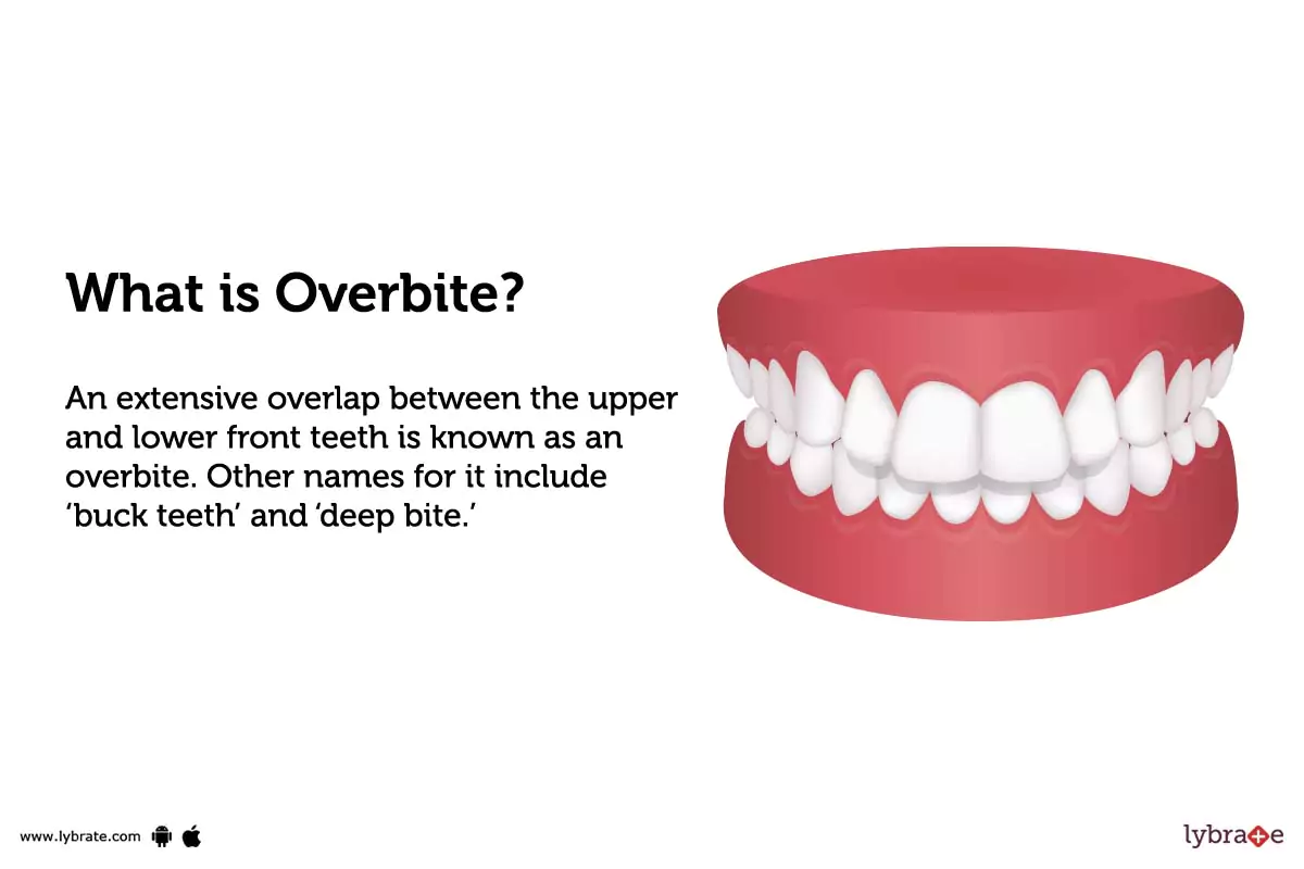 Overbite Treatment, Procedure, Cost, Recovery, Side Effects And More