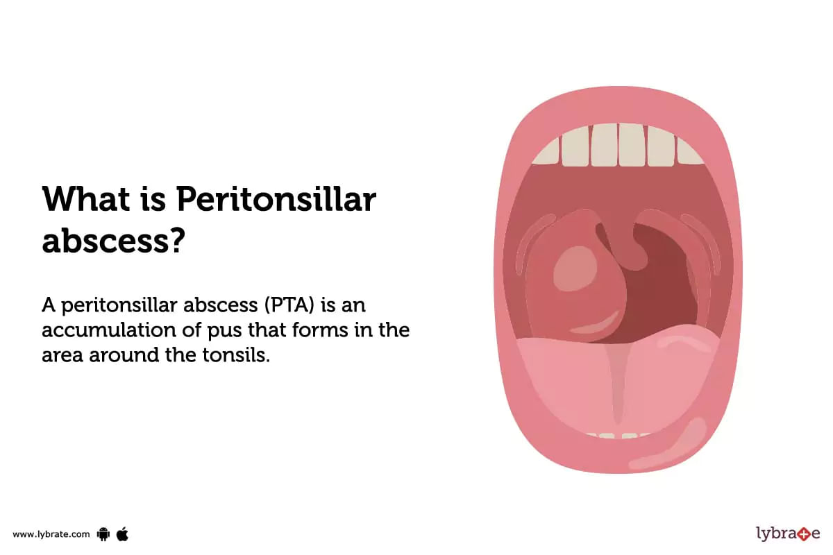 Peritonsillar Abscess Causes Symptoms Treatment And Cost 