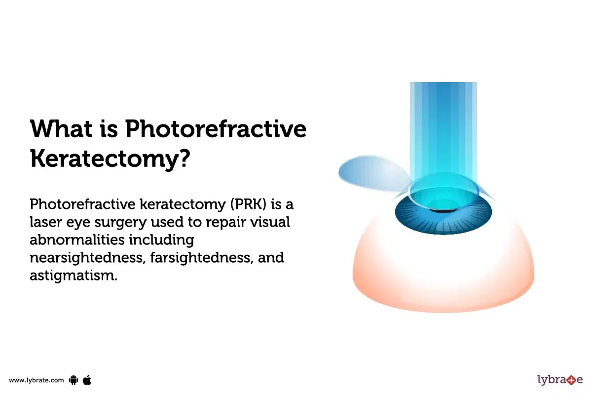 Photorefractive Keratectomy: Causes, Symptoms, Treatment And Cost