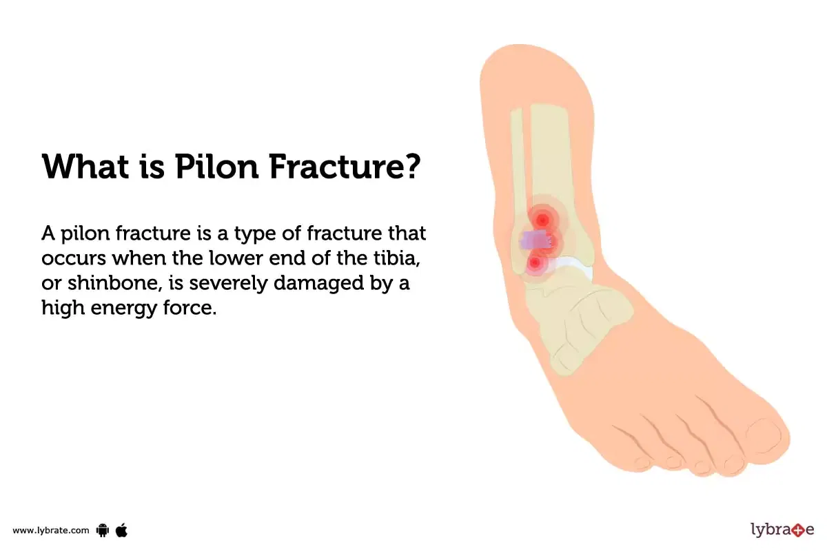Pilon fracture causes symptoms treatment and cost