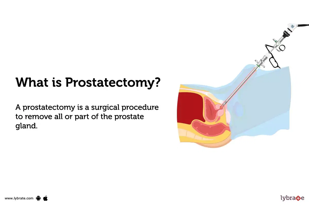 Prostatectomy Purpose Procedure Benefits And Side Effects