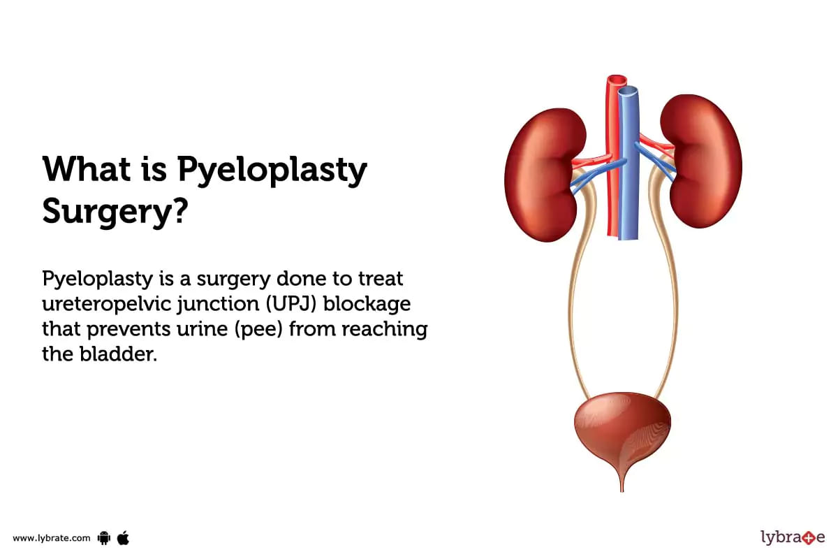 Pyeloplasty Surgery Purpose Procedure And Benefits And Side Effects