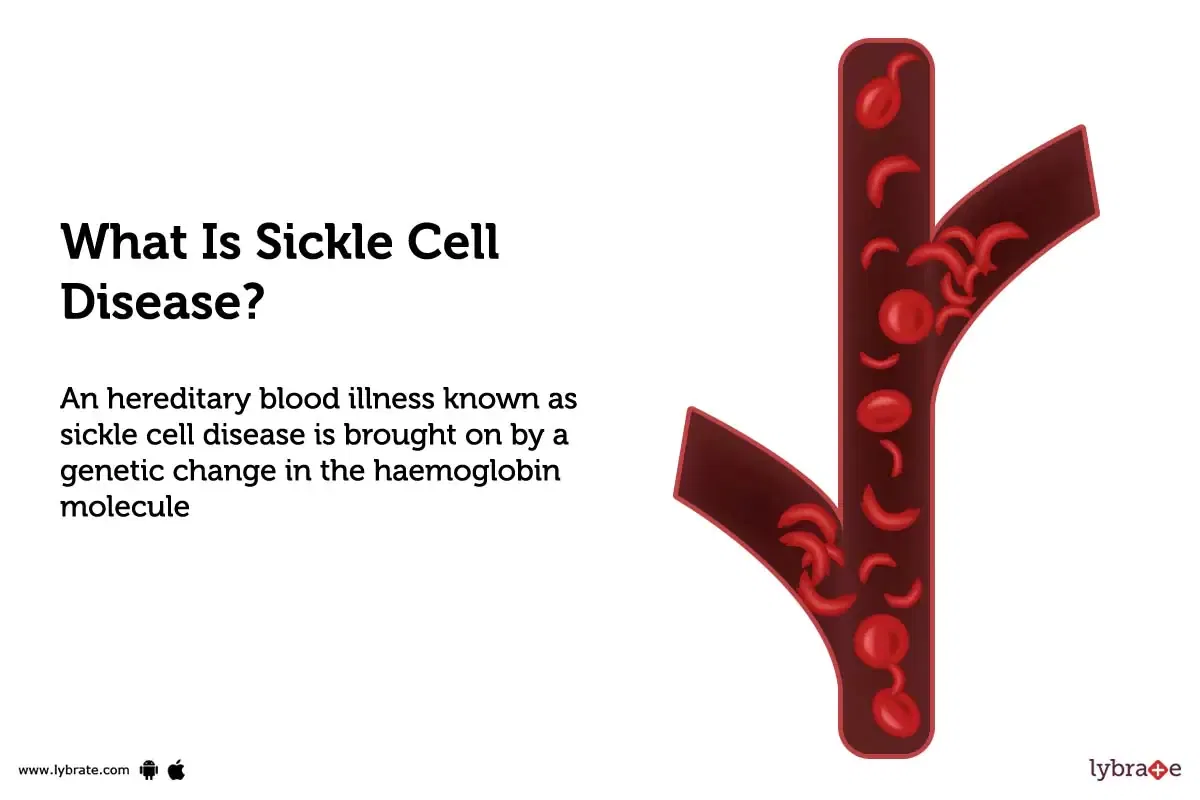 Sickle cell disease: Causes, Symptoms, Treatment and Cost