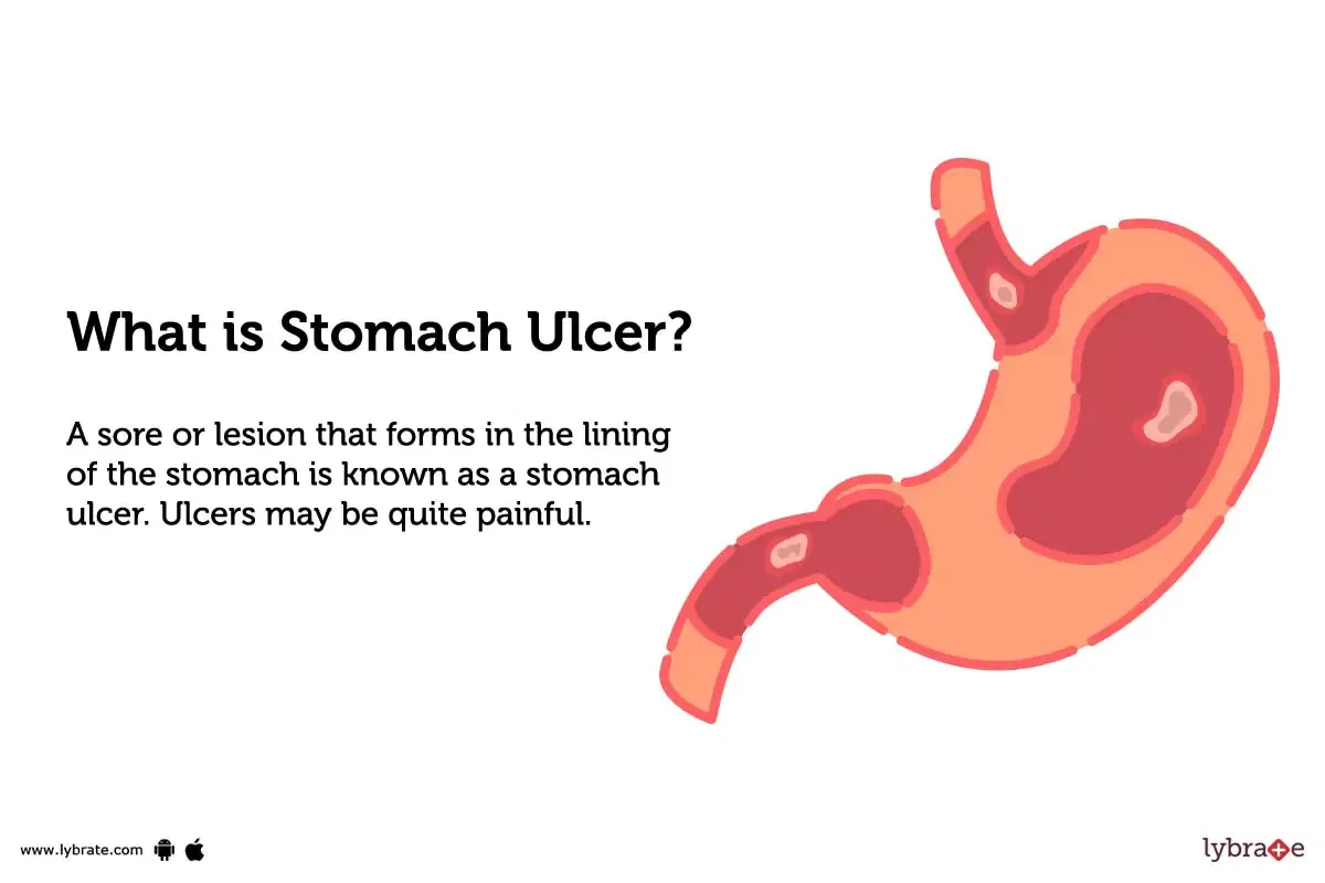 Stomach Ulcer Causes Symptoms Treatment And Cost