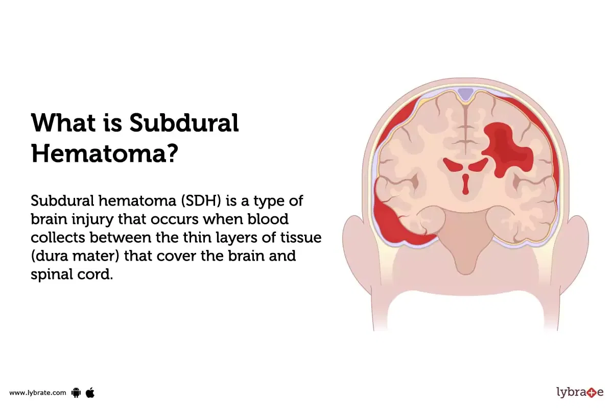 hematoma-subdural-hematoma-causes-diagnosis-hematoma-vrogue-co