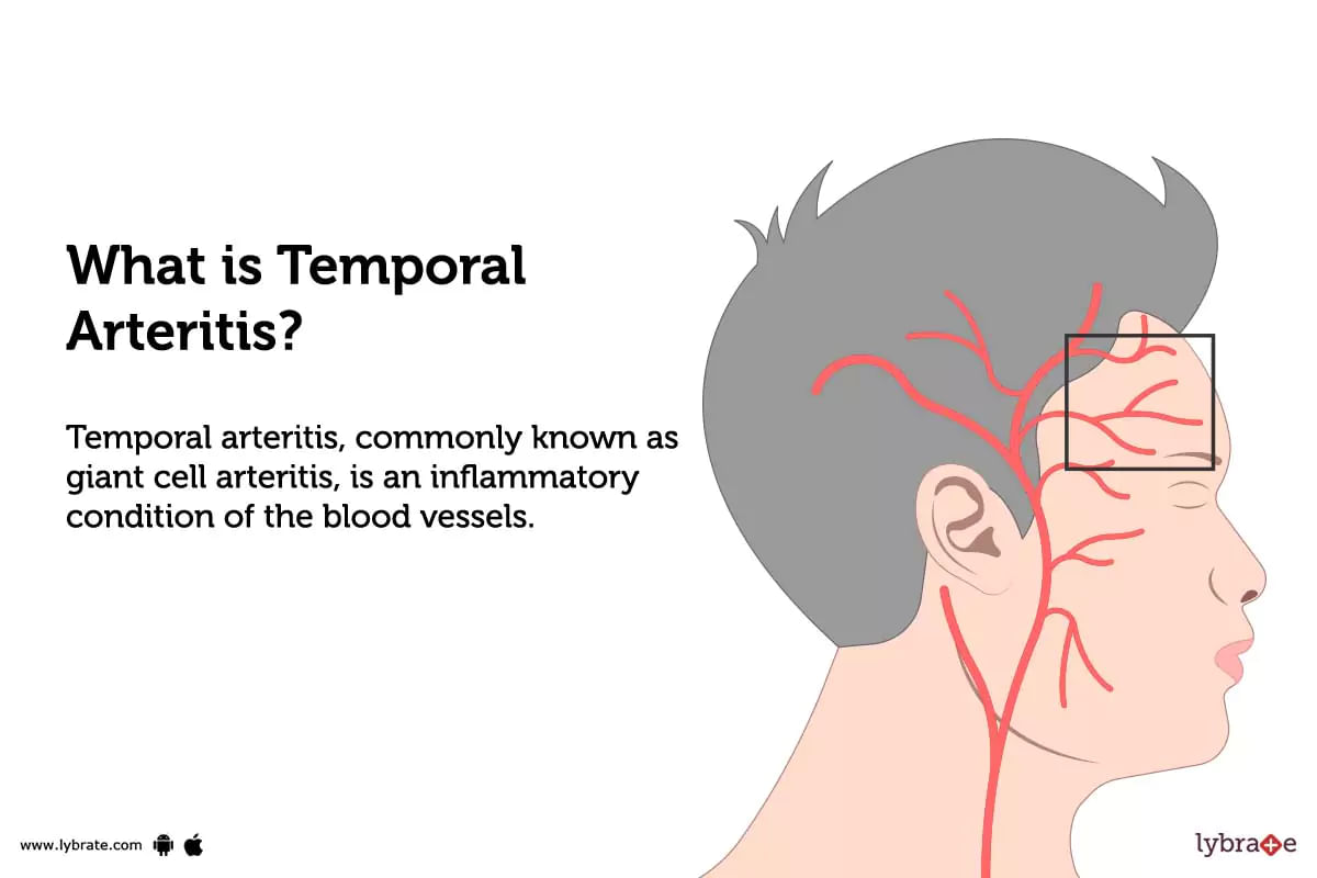 Temporal Arteritis Causes Symptoms Treatment And Cost