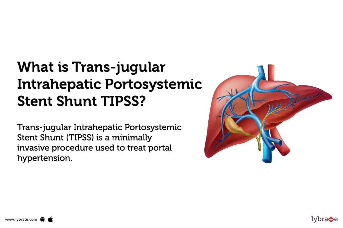 Transjugular Intrahepatic Portosystemic Stent Shunt Tipss: Causes ...