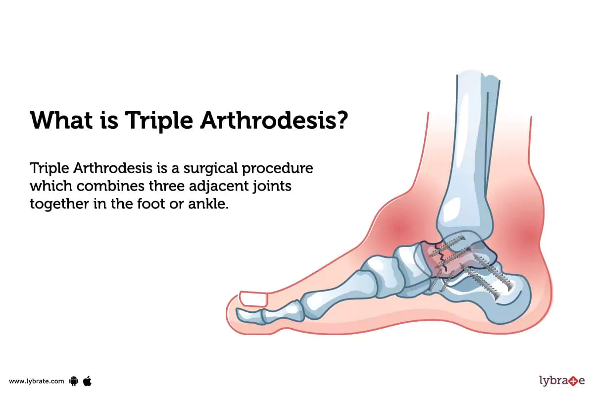 Triple Arthrodesis Purpose Procedure Benefits And Side Effects 