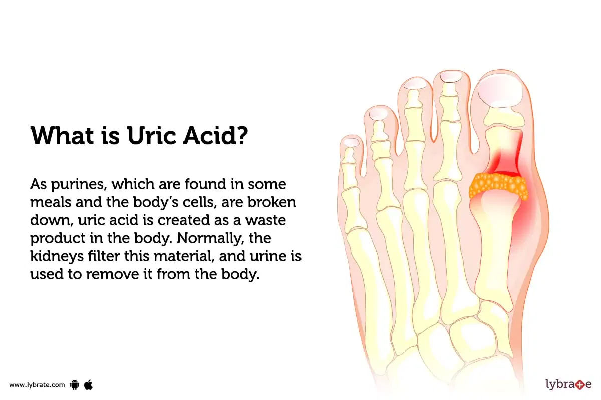 high-uric-acid-level-causes-risks-treatment-prevention