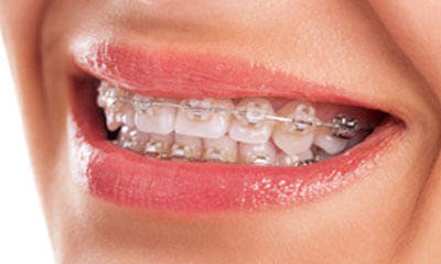 What Is Dental Caries?