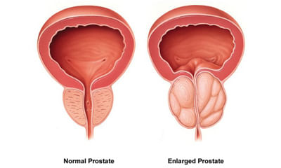 Enlarged Prostrate