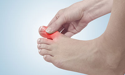 Foods To Avoid In Hyperuricemia (GOUT)