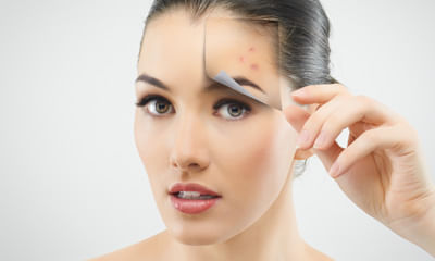 Tips for pimples or acne