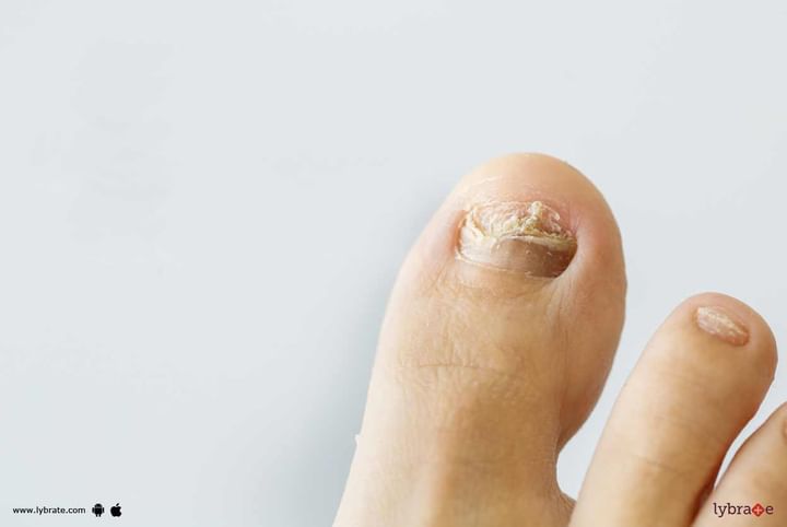 How To Treat Fungal Infection In Nails? - By Dr. Sunil Menon | Lybrate