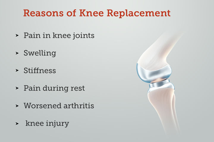 Knee Replacement: Procedure, Recovery, Cost, Risk & Complication