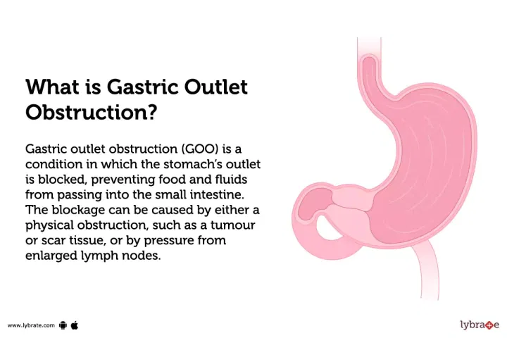 Gastric Outlet Obstruction: Causes, Symptoms, Treatment And Cost