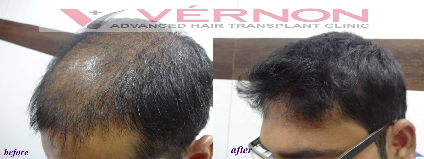FUE Hair Transplant Doctors in Hyderabad - View Cost, Book Appointment,  Consult Online
