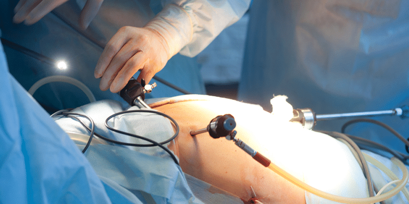 Details About Laparoscopic Surgery