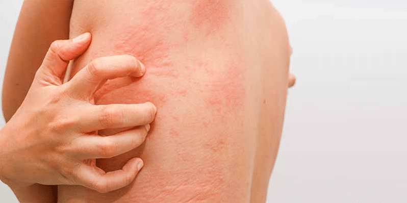 common-skin-rashes-skin-and-beauty-center-everyday-health