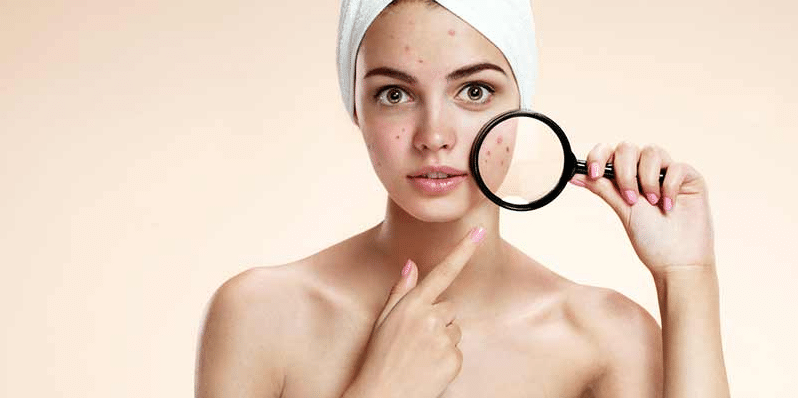 sneaky-causes-of-acne