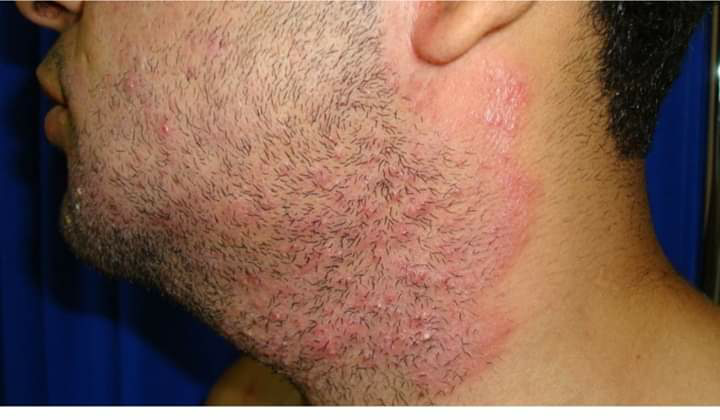 Pseudofolliculitis Barbae Tips Advice From Top Doctors Lybrate