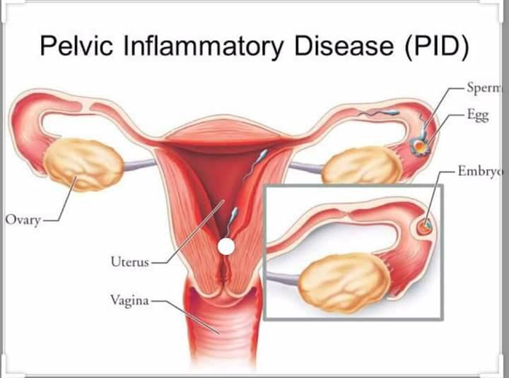 Can a Yeast Infection Cause Pelvic Inflammatory Disease?