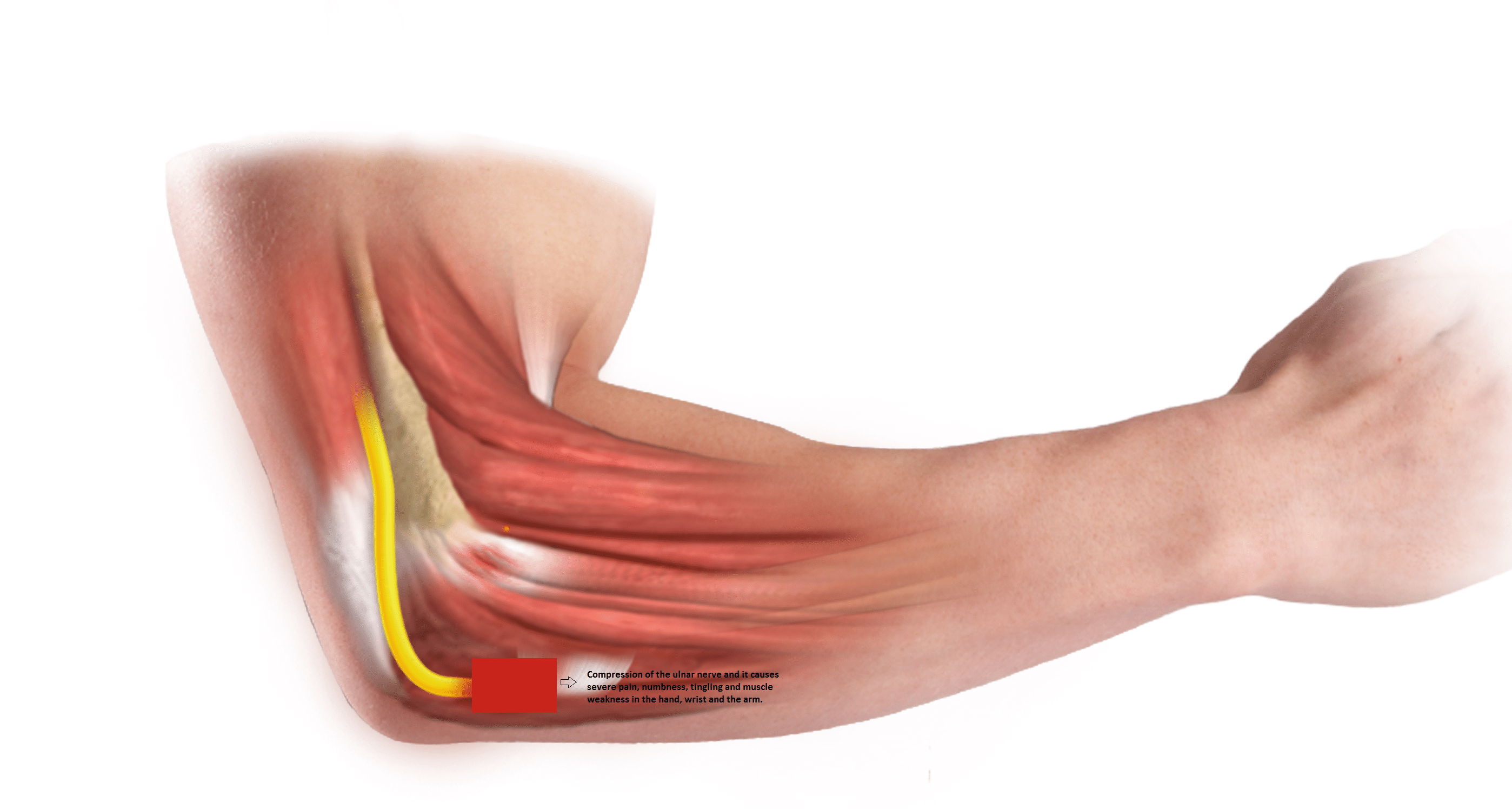 cubital-tunnel-syndrome-by-dr-mohit-madan-lybrate