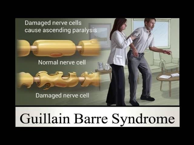 Treatment Of Guillain Barre Syndrome By Dr Radhika A Md Lybrate