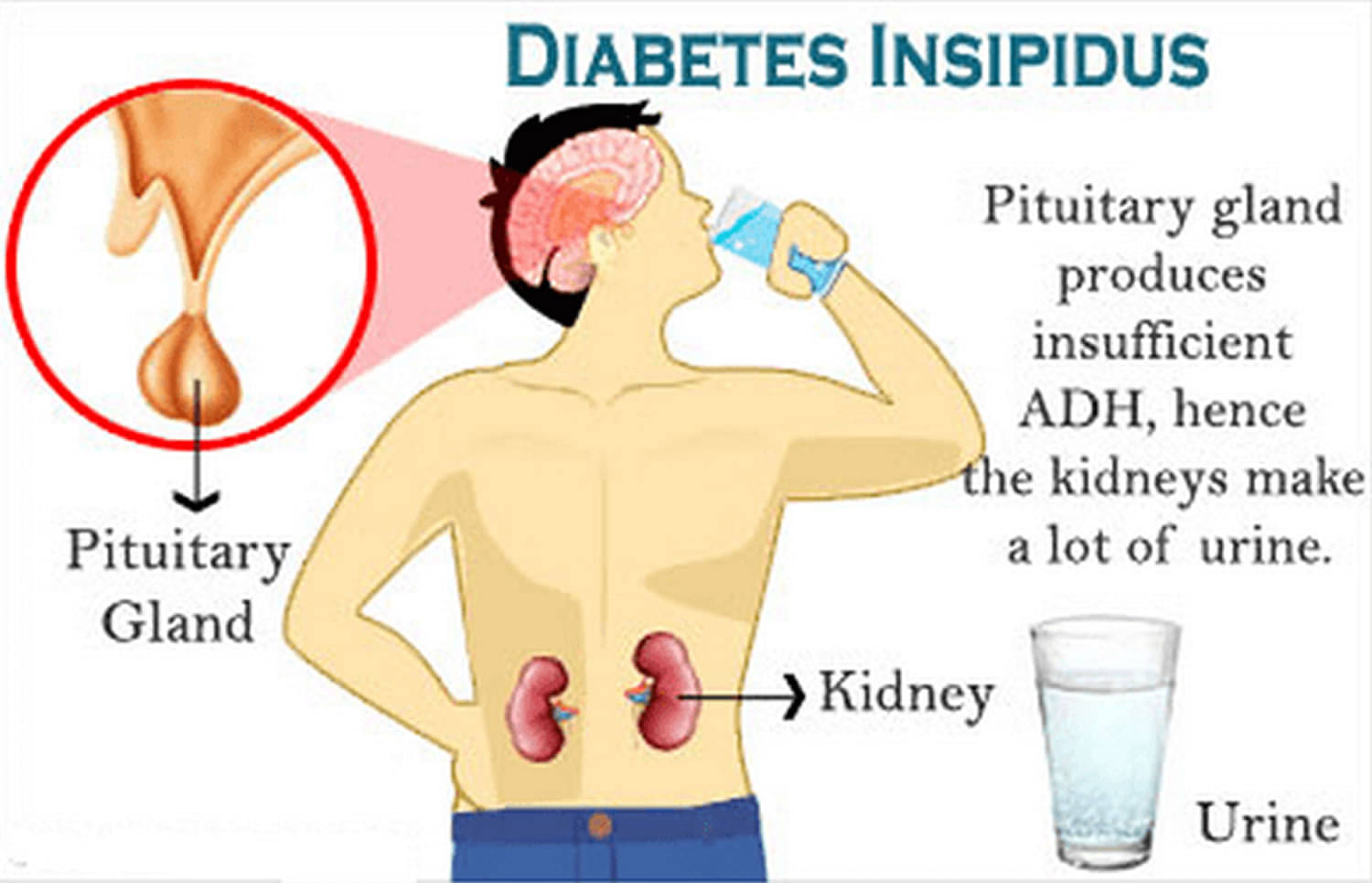 Diabetes Insipidus Wikipedia