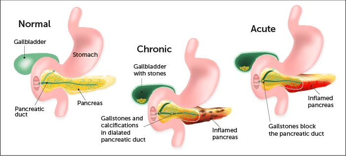 pancreatitis-know-more-of-it-by-dr-radhika-a-md-lybrate