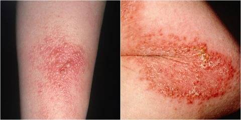 Poison Ivy Rash! - By Dr. Radhika A (Md) | Lybrate