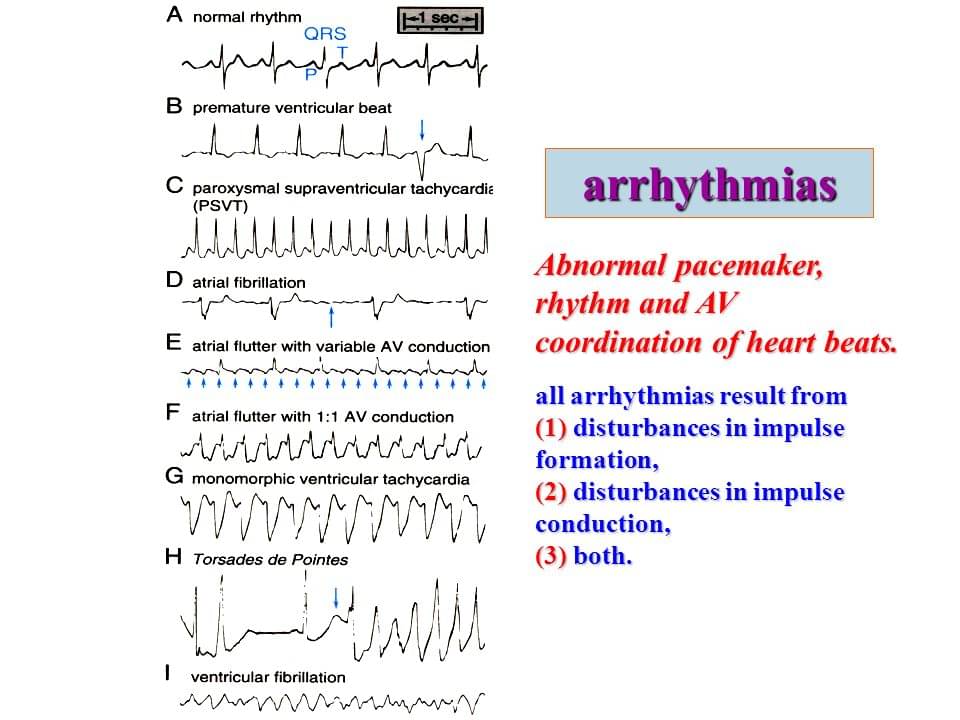 types-of-heart-arrhythmias-by-best-heart-arrhythmia-specialist-in-india