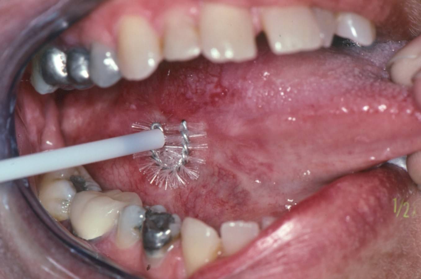 ORAL BRUSH BIOPSY - By Dr. Ehtisham Ansari | Lybrate