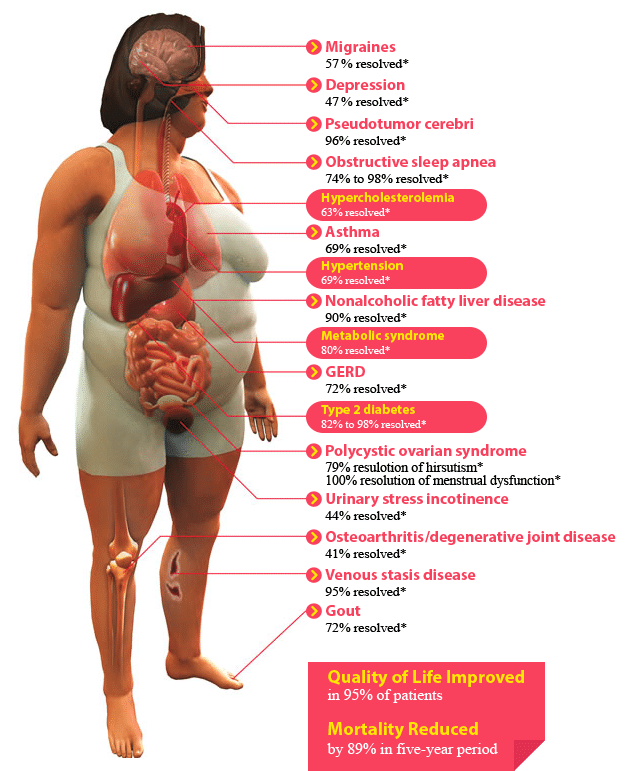 Bariatric Surgery Prepration - By Dr. Chintan B Patel ...