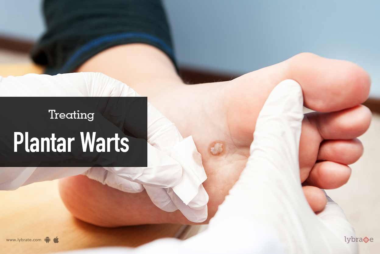 Treating Plantar Warts - By Dr. Nivedita Dadu | Lybrate