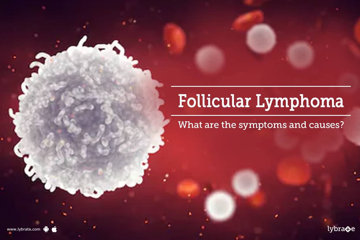 follicular-lymphoma-what-are-the-symptoms-and-causes-by-dr-garima