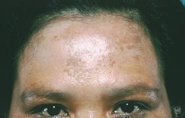 skin treatment hyderabad Treatment and  Melasma Causes Venu : Signs  By Dr. Kumari