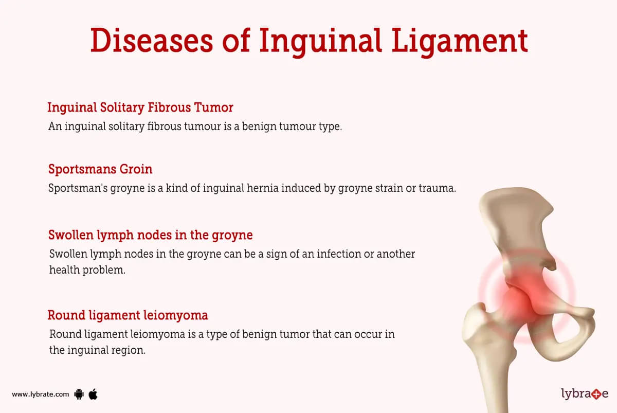Ilioinguinal Ligament Pain: Relieve Groin Pain with Ilioinguinal Ligament  Support!