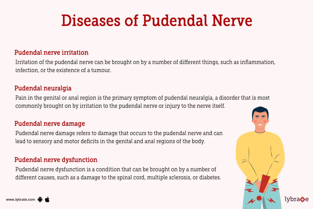 A Guide to Pudendal Neuralgia: Symptoms, Causes and Treatment Options