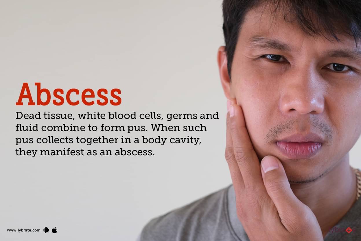 abscess-symptoms-causes-treatment-cost-and-side-effects